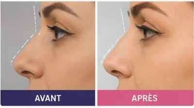 Affinement du nez