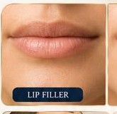 Lip Filler
